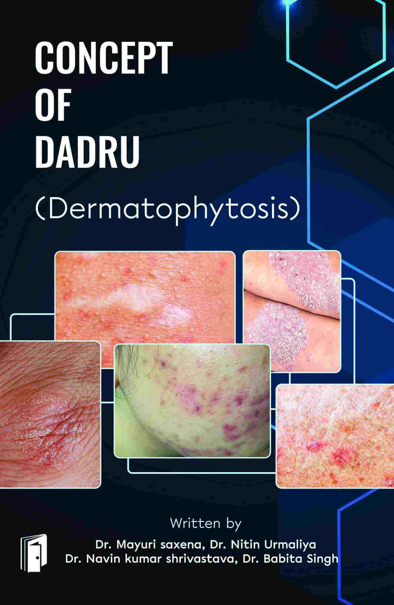 Concept Of Dadru (Dermatophytosis)